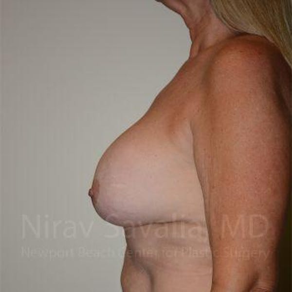 Breast Lift with Implants Before & After Gallery - Patient 1655483 - Image 11