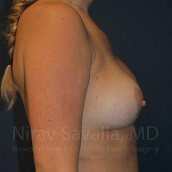 Breast Implant Revision Before & After Gallery - Patient 1655486 - Image 3