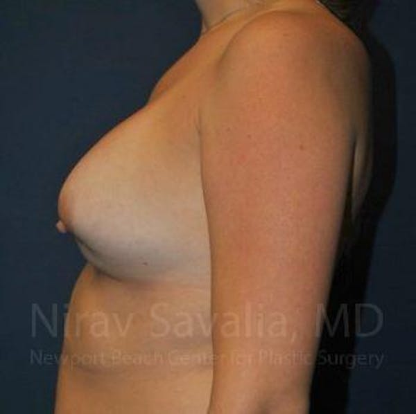 Breast Implant Revision Before & After Gallery - Patient 1655486 - Image 5