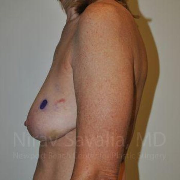 Oncoplastic Reconstruction Before & After Gallery - Patient 1655487 - Image 7