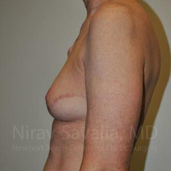 Oncoplastic Reconstruction Before & After Gallery - Patient 1655487 - Image 8