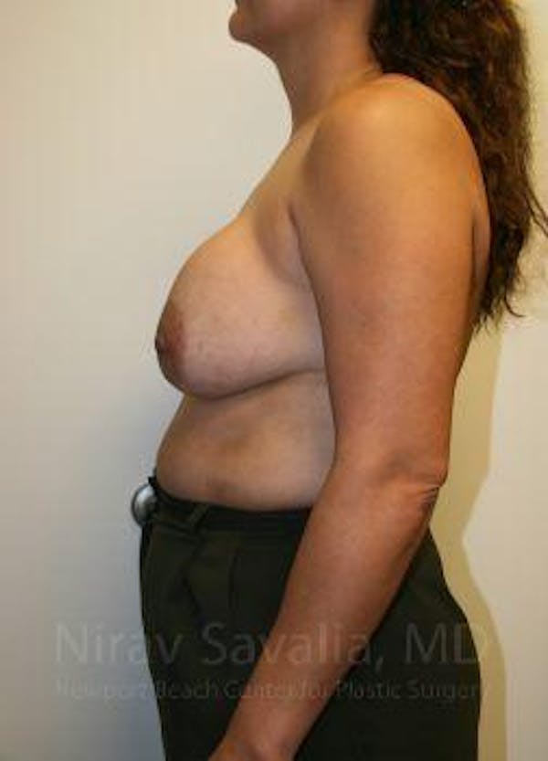 Breast Lift with Implants Before & After Gallery - Patient 1655490 - Image 7