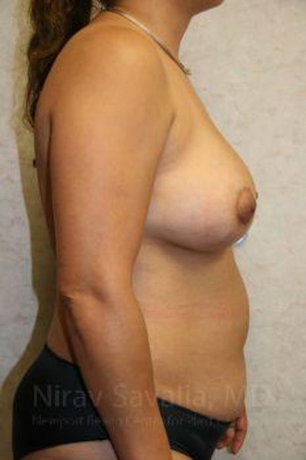 Breast Lift with Implants Before & After Gallery - Patient 1655490 - Image 10