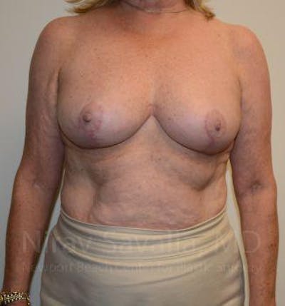 Breast Reduction Before & After Gallery - Patient 1655496 - Image 2