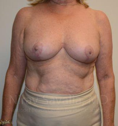 Breast Reduction Gallery - Patient 1655496 - Image 2