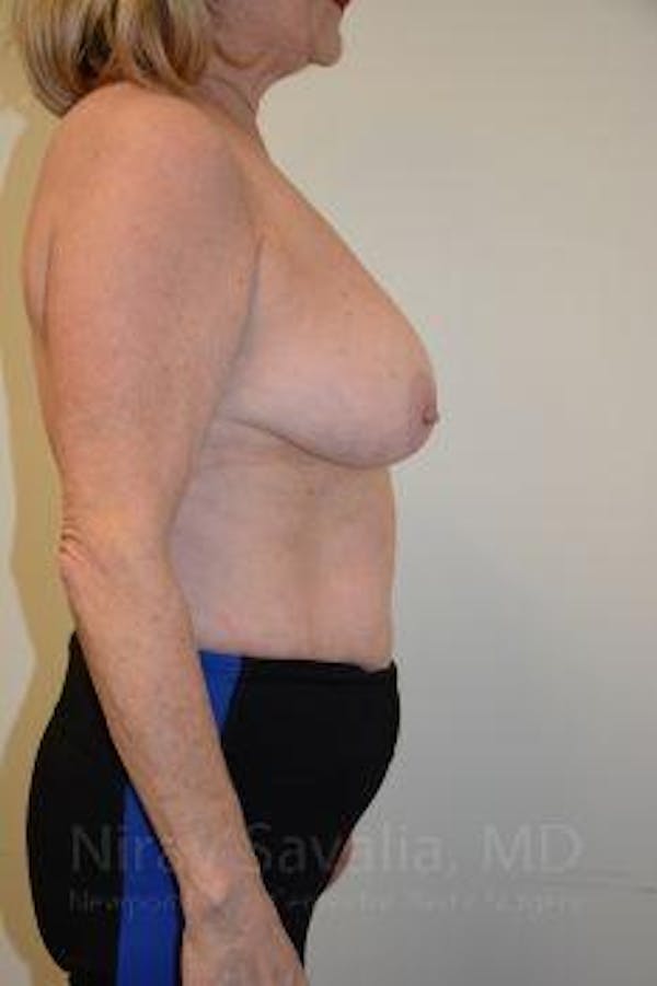 Breast Reduction Before & After Gallery - Patient 1655496 - Image 5