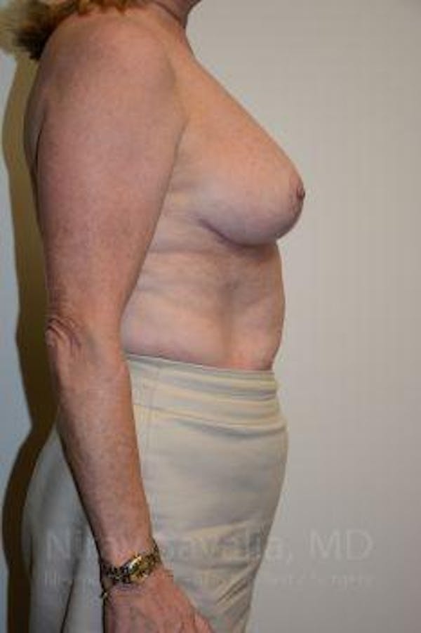 Breast Reduction Before & After Gallery - Patient 1655496 - Image 6
