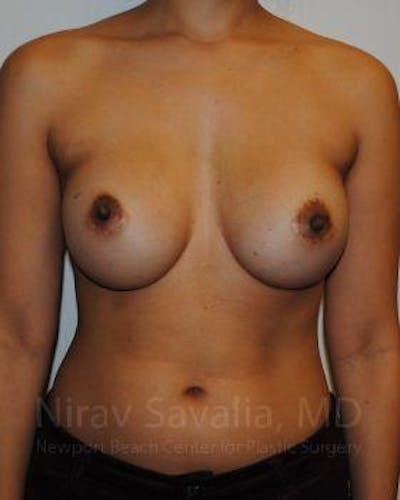 Mastectomy Reconstruction Gallery - Patient 1655498 - Image 1