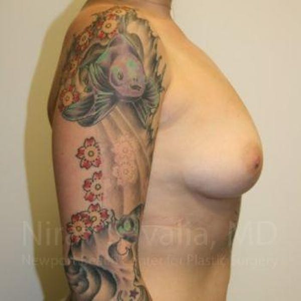 Breast Augmentation Before & After Gallery - Patient 1655500 - Image 3