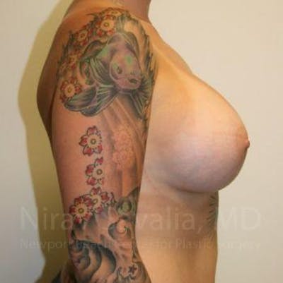 Breast Augmentation Before & After Gallery - Patient 1655500 - Image 4