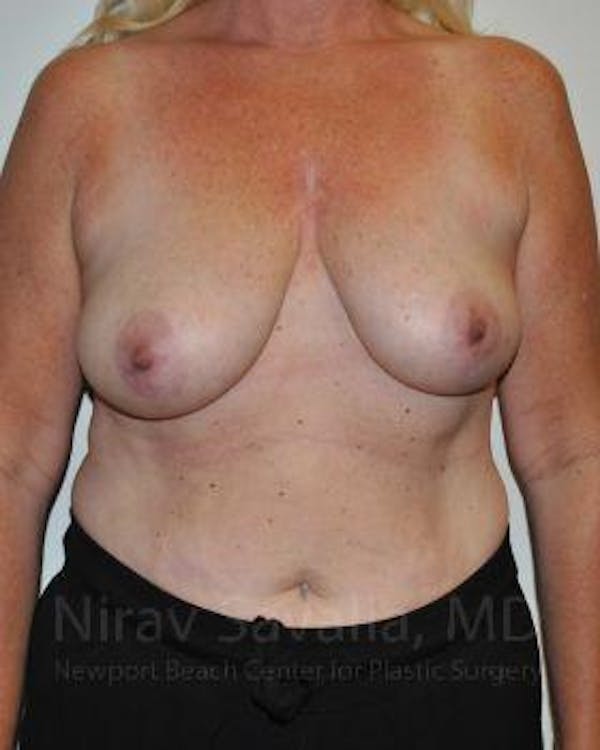 Oncoplastic Reconstruction Before & After Gallery - Patient 1655499 - Image 1