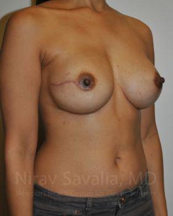Mastectomy Reconstruction Before & After Gallery - Patient 1655498 - Image 4