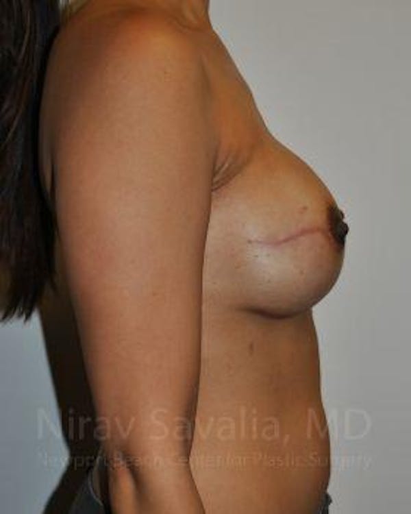 Mastectomy Reconstruction Gallery - Patient 1655498 - Image 6