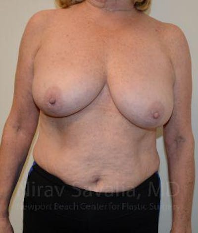 Breast Lift without Implants Before & After Gallery - Patient 1655501 - Image 1