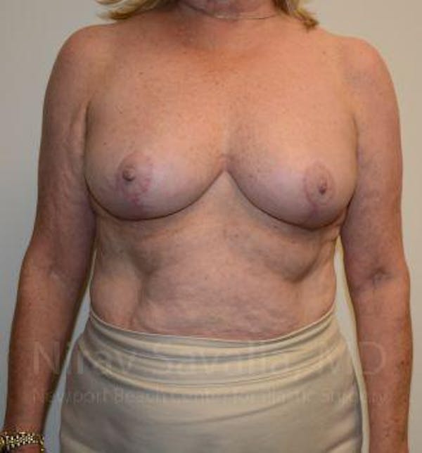 Breast Lift without Implants Before & After Gallery - Patient 1655501 - Image 2
