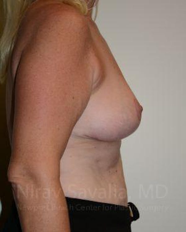 Oncoplastic Reconstruction Before & After Gallery - Patient 1655499 - Image 6