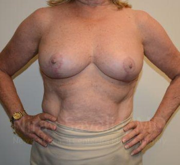 Breast Lift without Implants Gallery - Patient 1655501 - Image 4