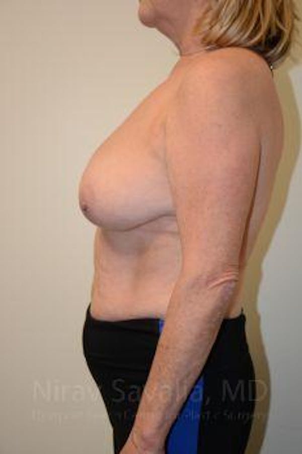 Breast Lift without Implants Before & After Gallery - Patient 1655501 - Image 7