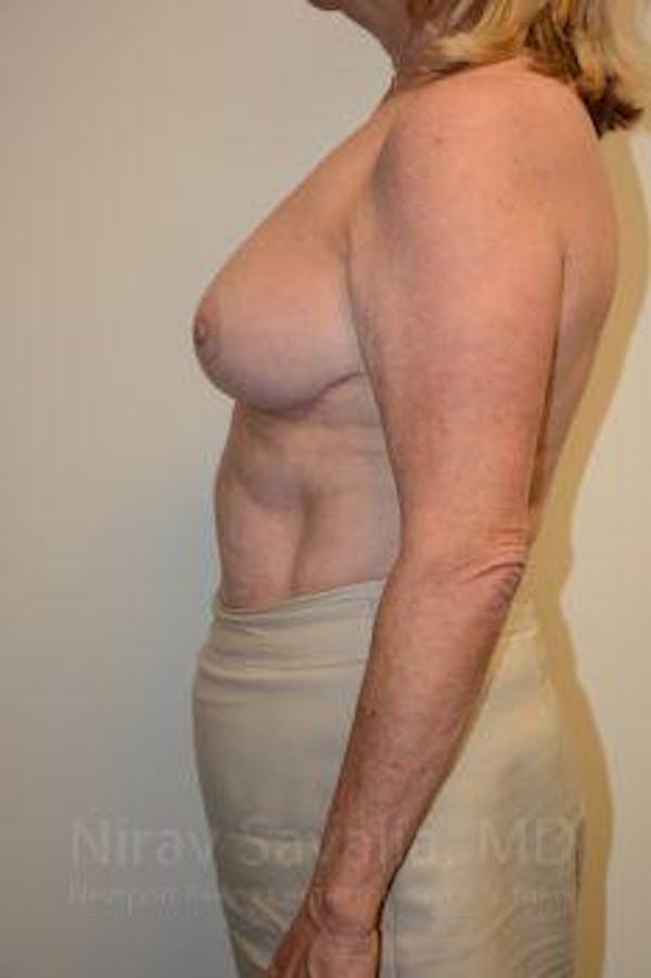 Breast Lift without Implants Before & After Gallery - Patient 1655501 - Image 8