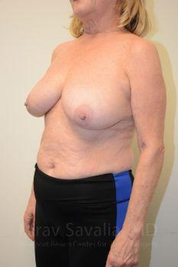 Breast Lift without Implants Before & After Gallery - Patient 1655501 - Image 9