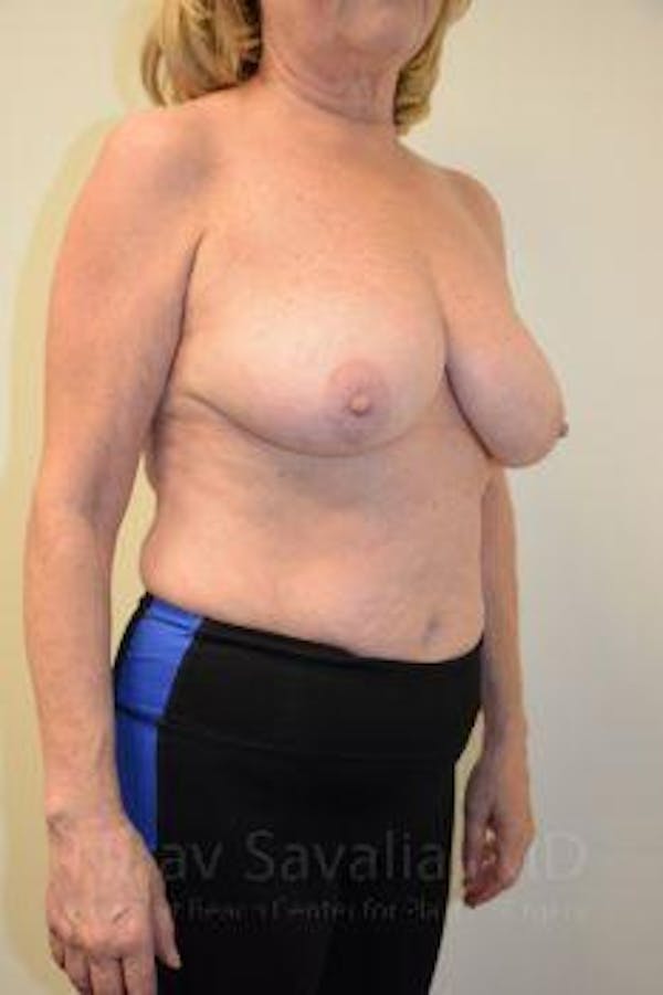 Breast Lift without Implants Before & After Gallery - Patient 1655501 - Image 11