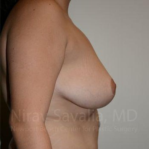 Breast Reduction Before & After Gallery - Patient 1655504 - Image 6