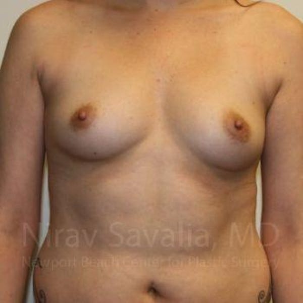 Breast Augmentation Before & After Gallery - Patient 1655506 - Image 1