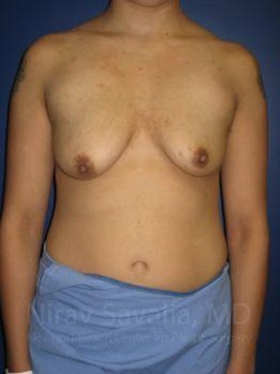 Breast Lift with Implants Before & After Gallery - Patient 1655508 - Image 1