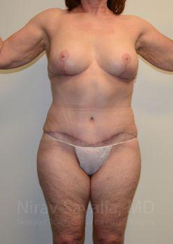 Breast Lift without Implants Before & After Gallery - Patient 1655509 - Image 2