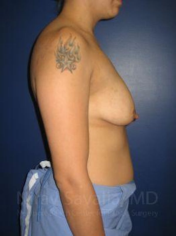 Breast Lift with Implants Before & After Gallery - Patient 1655508 - Image 3