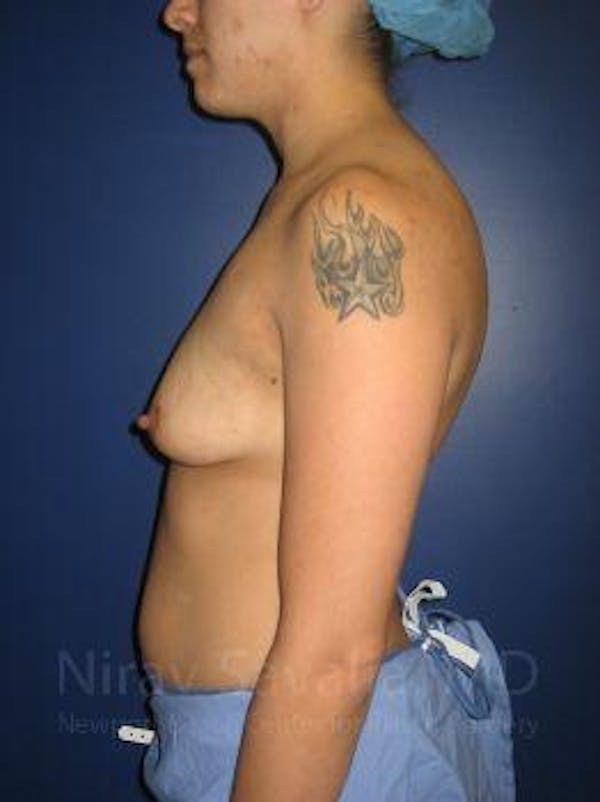 Breast Lift with Implants Before & After Gallery - Patient 1655508 - Image 5