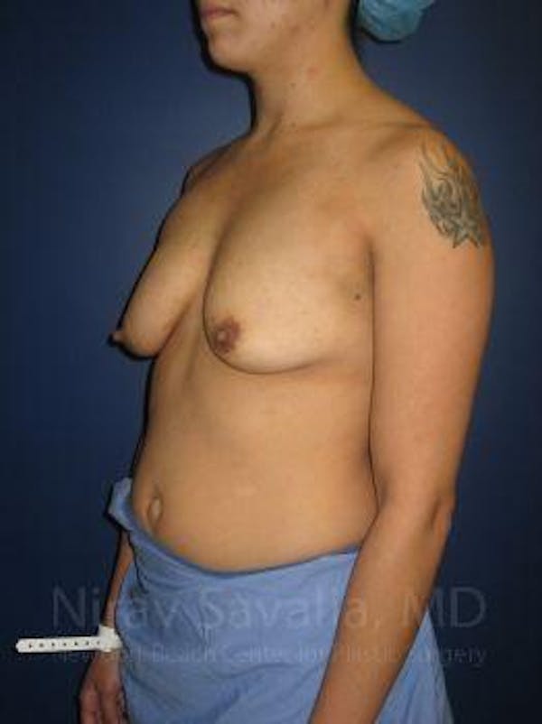 Breast Lift with Implants Before & After Gallery - Patient 1655508 - Image 9