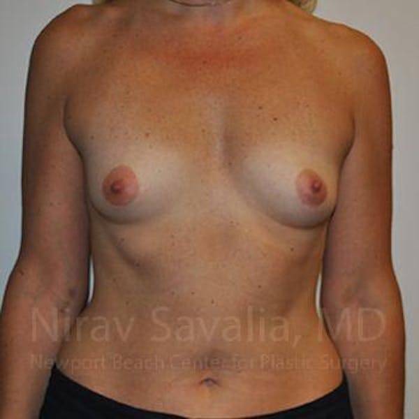 Breast Augmentation Before & After Gallery - Patient 1655512 - Image 1