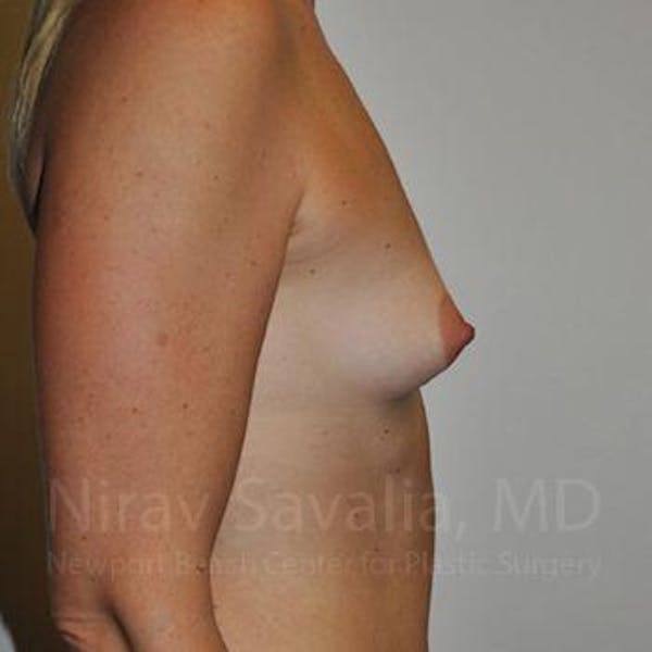 Breast Augmentation Before & After Gallery - Patient 1655512 - Image 5