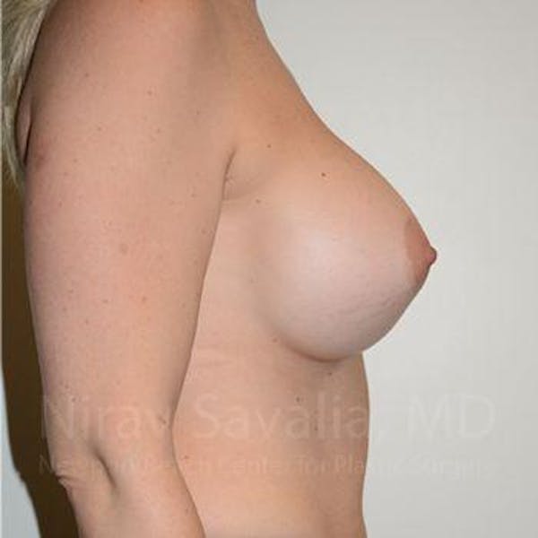 Breast Augmentation Before & After Gallery - Patient 1655512 - Image 6