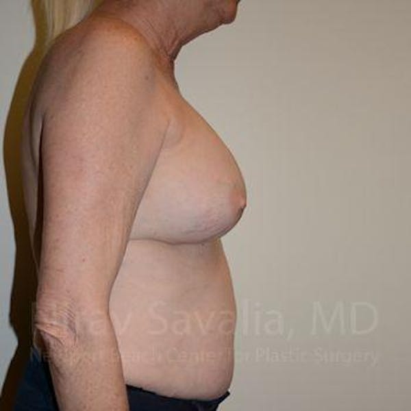 Breast Implant Revision Before & After Gallery - Patient 1655513 - Image 3