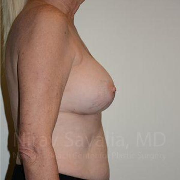 Breast Implant Revision Before & After Gallery - Patient 1655513 - Image 4