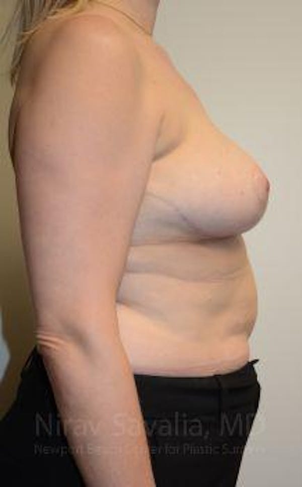 Breast Reduction Before & After Gallery - Patient 1655516 - Image 8