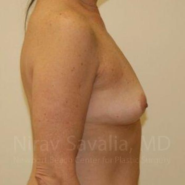 Breast Augmentation Before & After Gallery - Patient 1655519 - Image 3