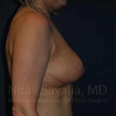 Oncoplastic Reconstruction Before & After Gallery - Patient 1655517 - Image 8