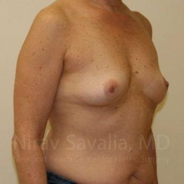 Breast Augmentation Before & After Gallery - Patient 1655519 - Image 5
