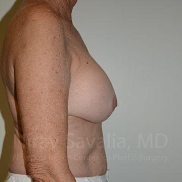 Breast Implant Revision Before & After Gallery - Patient 1655520 - Image 3