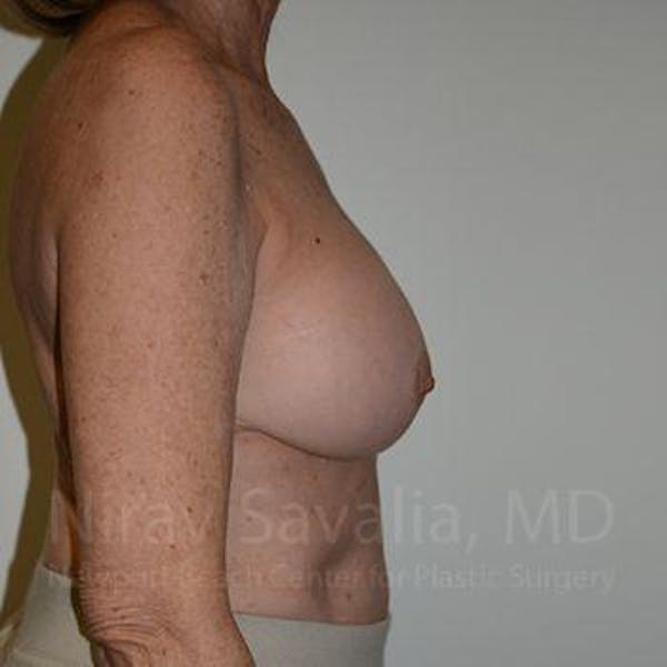 Breast Implant Revision Before & After Gallery - Patient 1655520 - Image 4