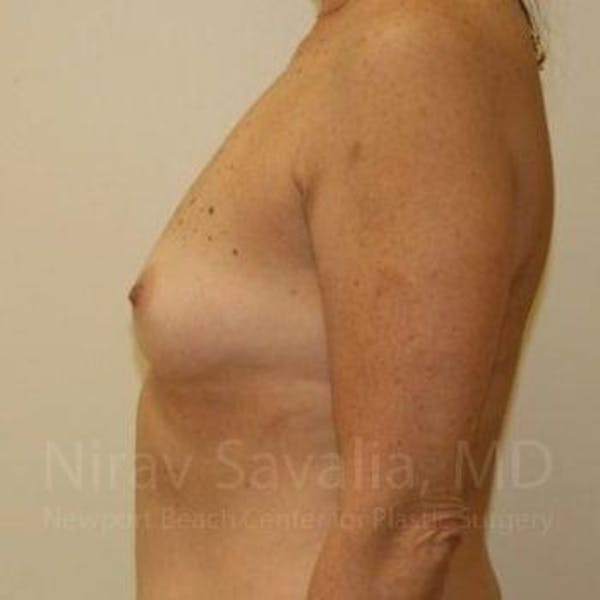 Breast Augmentation Before & After Gallery - Patient 1655519 - Image 9