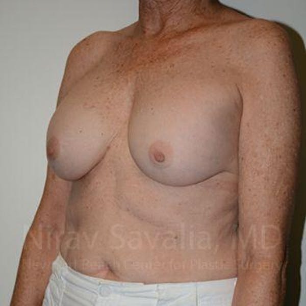 Breast Implant Revision Before & After Gallery - Patient 1655520 - Image 7