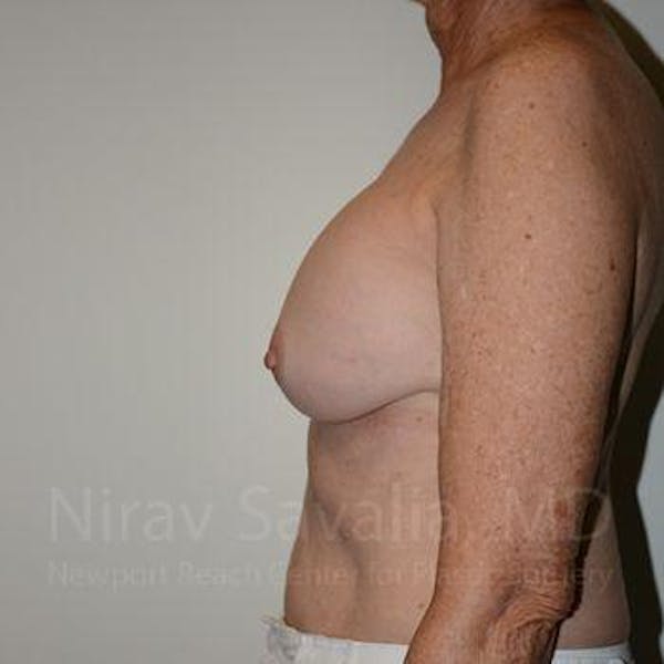 Breast Implant Revision Before & After Gallery - Patient 1655520 - Image 9