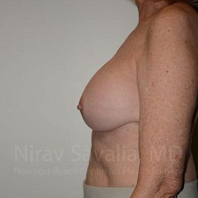 Breast Implant Revision Before & After Gallery - Patient 1655520 - Image 10