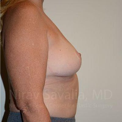 Oncoplastic Reconstruction Before & After Gallery - Patient 1655523 - Image 6