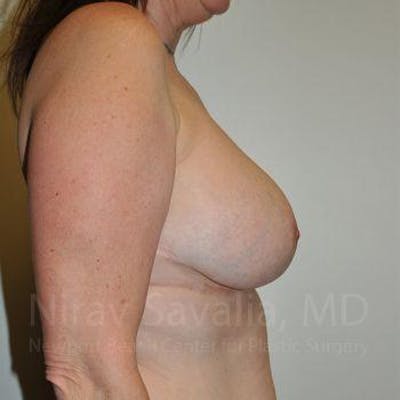 Breast Lift with Implants Before & After Gallery - Patient 1655526 - Image 8