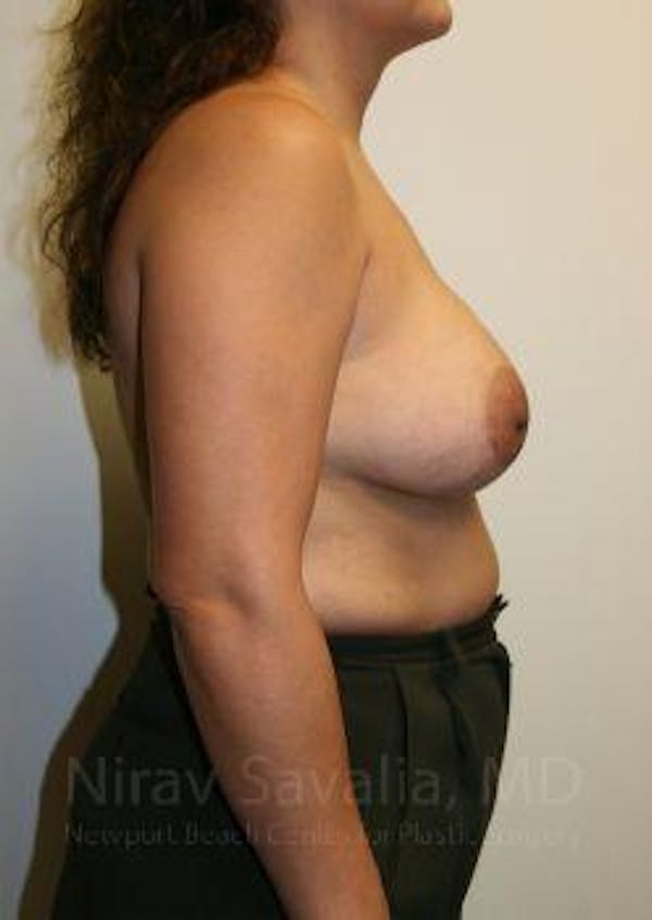 Breast Implant Revision Gallery - Patient 1655529 - Image 9